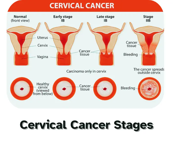 cervical cancer kya hai