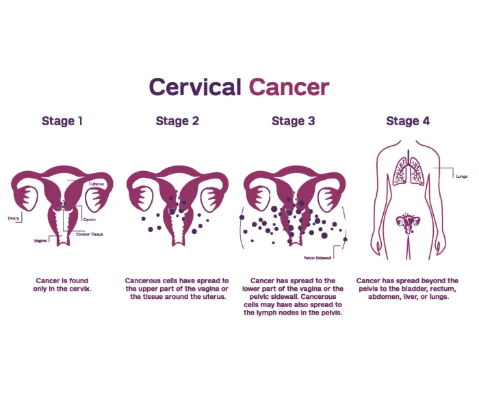 cervical cancer ki pehchan